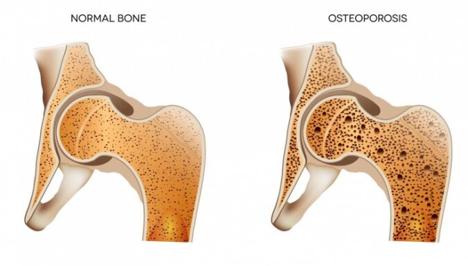 Osteoporozes dēļ kauli var lūzt pat nošķaudoties. Ārsta ieteikumi profilaksei