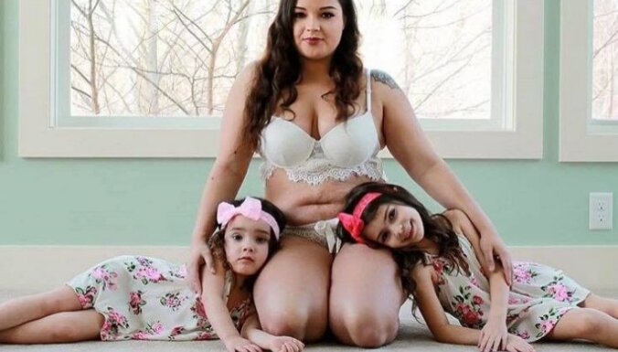 ФОТО. Публикуя снимки растяжек, молодая мама хочет вдохновить женщин полюбить свое тело