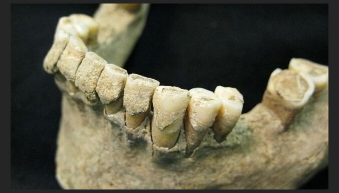 Atklāti 1000 gadus seni cilvēka zobu bojājumi